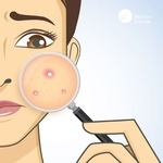 Composto Oral para Tratamento da Acne e Rosácea