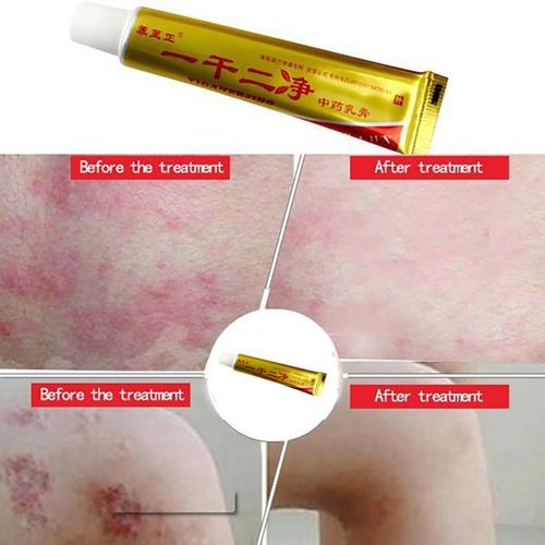 Herbal Antibacterial Medicated Unguento Dermatite Eczema Psoríase Tratamento