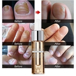 Prego Repair Solução Anti fungo onicomicose Repair crack Toe Nail Cuidados Líquido Essencial