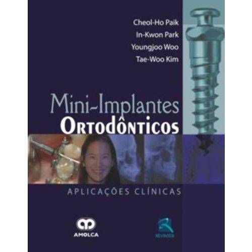 Mini-implantes Ortodonticos