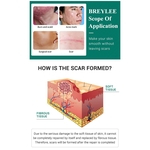 Reparação Scar Creme da remoção Creme Acne Cicatrizes Estrias para o Corpo pigmentação Corrector Cuidados