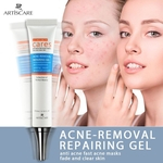 Tratamento de Acne Blackhead Remova Anti Acne Creme Oil Control encolher poros Acne Scar Retirar Face Care