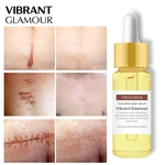 VIBRANTE GLAMOUR Repair pele Cicatriz Remoção face Serum Acne Scar Whitening Spots Essence Acne Tratamento Estrias Cuidados com a pele