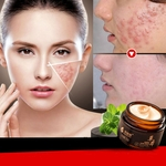 Ficha técnica e caractérísticas do produto Herbal Acne Creme Anti Pimple Acne Scars Blackhead Remoção creme de clareamento da pele Creme Face Care